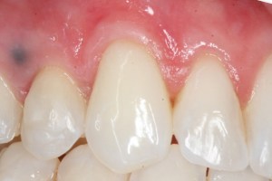 Patient's mouth after gum grafting