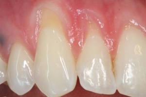 Patient's mouth before gum grafting