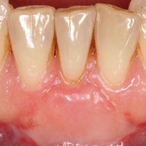 Patient's mouth after gum grafting