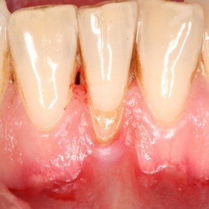 Patient's mouth before gum grafting