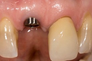 Patient's mouth with a dental implant without a crown