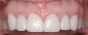 Patient's teeth after crown lengthening