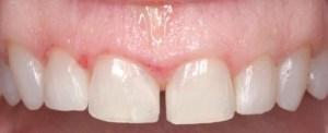 Patient's teeth before crown lengthening