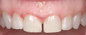 Patient's teeth before crown lengthening