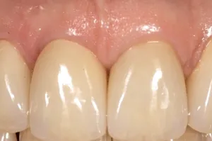 Patient's mouth after placing a dental implant with a crown